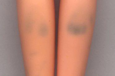 Leg Stains